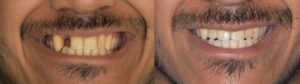 Missing front tooth replacement