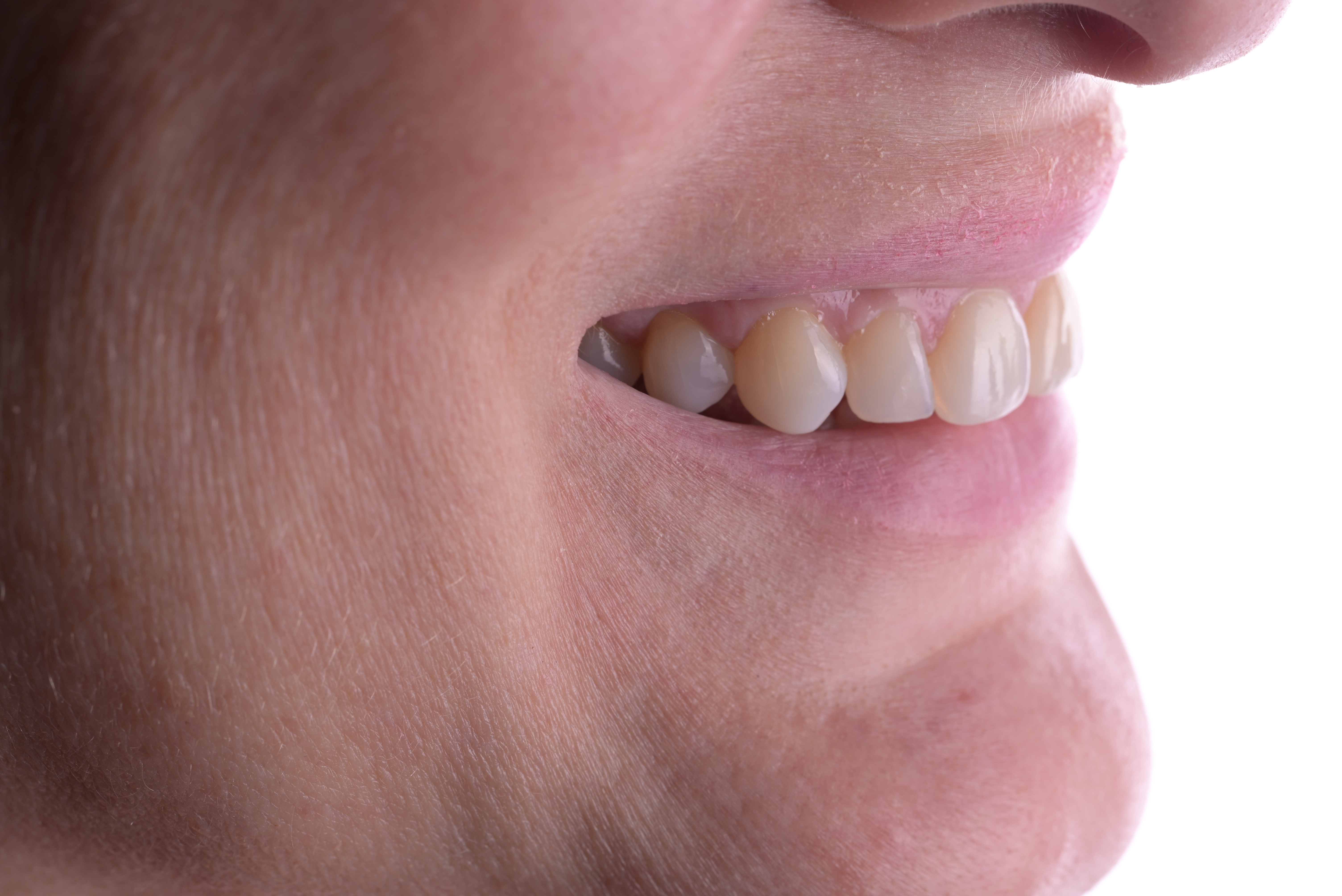veneers