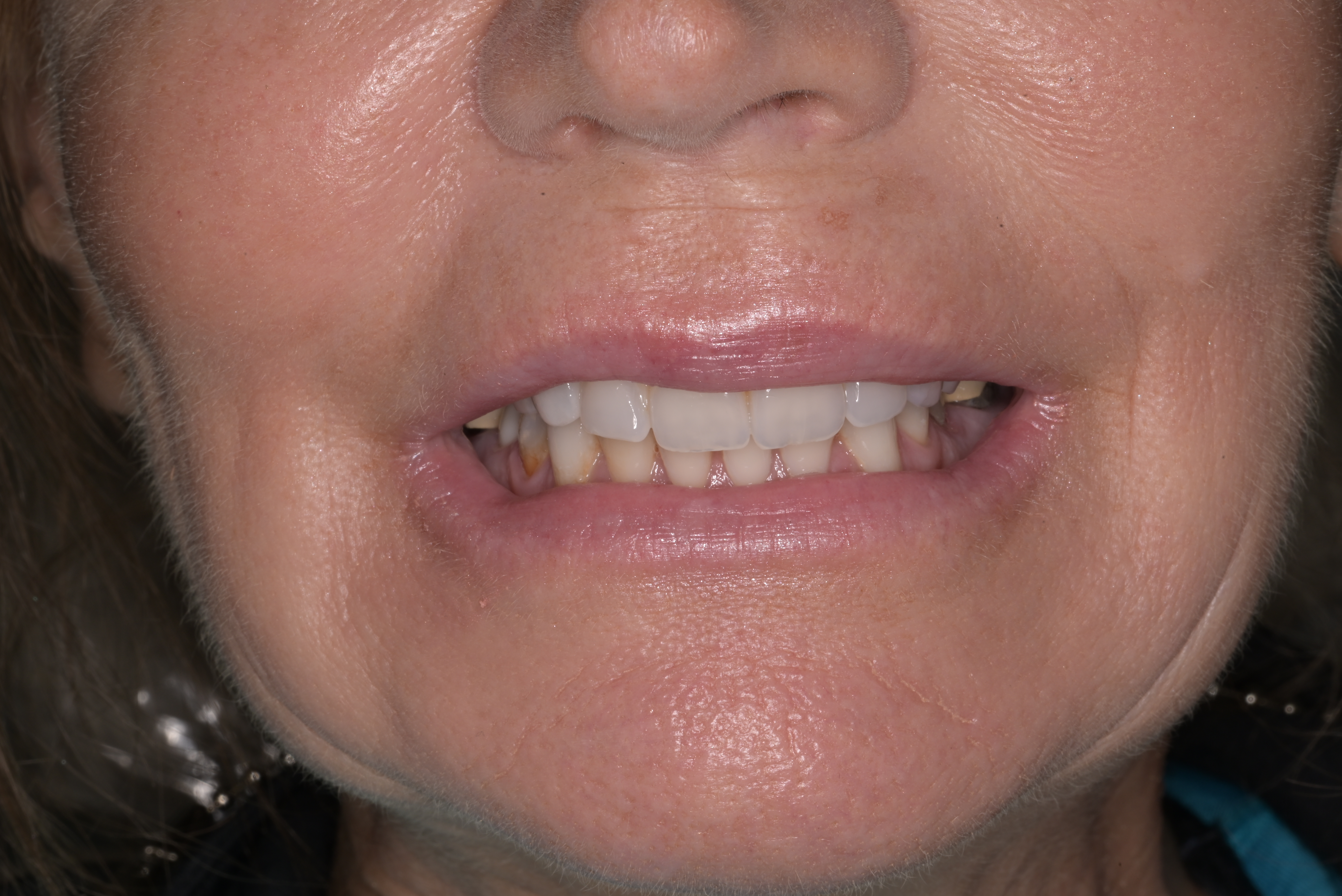 dental implants